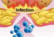 infection